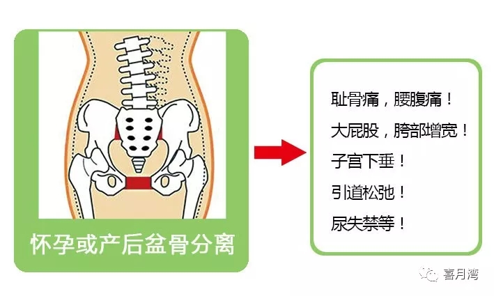 骨盆修复